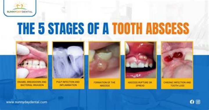 Can a tooth abscess cause acne?