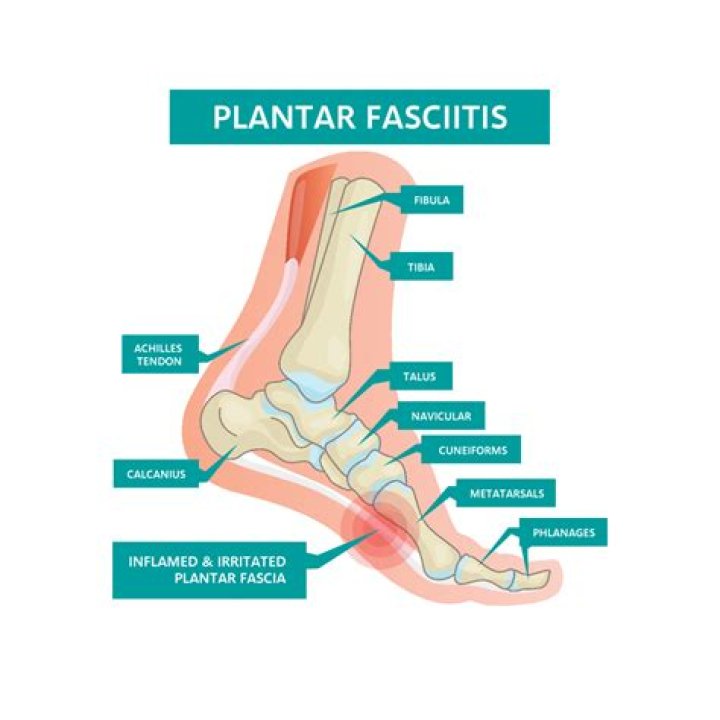 Can Plantar fasciitis cause other foot problems?